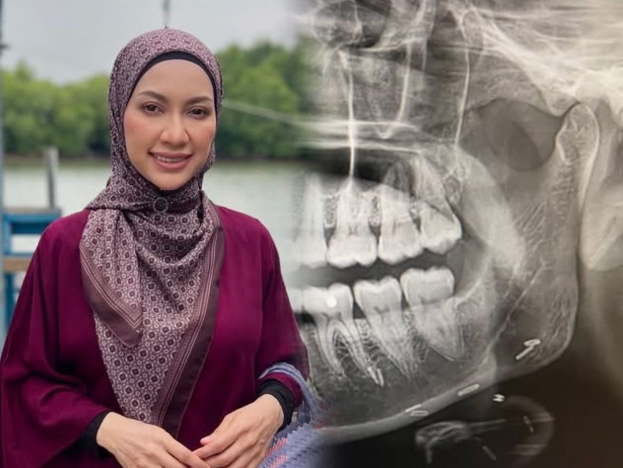 Zara Zya disangka pakai susuk, rupa-rupanya kesan pembedahan