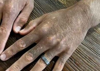 PERUBAHAN warna kulit dipercayai selepas lelaki itu mengambil ubat antikemurungan. -AGENSI