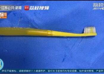 BERUS gigi berjaya dikeluarkan dari perut seorang lelaki selepas pembedahan dilakukan. -AGENSI