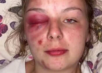 ELEANOR WILLIAMS memuat naik gambar di media sosial menunjukkan kecederaan di wajahnya kononnya akibat dipukul.-AGENSI