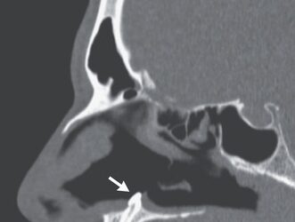IMBASAN X-ray menunjukkan gigi tumbuh dalam lubang hidung lelaki tersebut. - NEJM