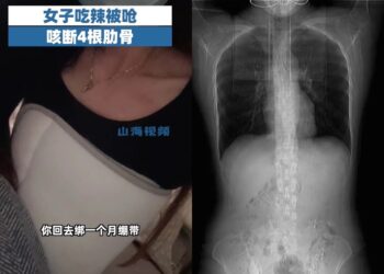 HUANG terpaksa menggunakan korset khas selepas tulang rusuknya patah ketika dia tersedak selepas menikmati makanan pedas.-AGENSI