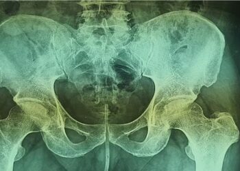 KEPUTUSAN X-ray menunjukkan wayar (tengah) berada di dalam uretra lelaki itu. - AGENSI  