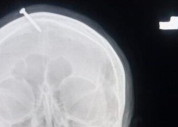 IMBASAN X-ray menunjukkan paku sepanjang lima cm menembusi bahagian atas dahi wanita tersebut.-LADY READING HOSPITAL