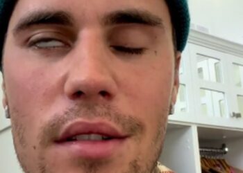 JUSTIN Bieber mendedahkan mengalami sindrom Ramsay Hunt. - AGENSI