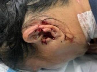 IBU bayi mengalami kecederaan pada bahagian tengkuk dan hampir putus telinga-IHSAN PDRM