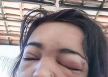 MANGSA mengalami bengkak di bahagian mata selepas menindik kening sendiri. - NEWSFLASH