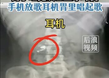 IMBASAN X-ray menunjukkan fon telinga itu berada dalam usus Xiaoyong. - AGENSI