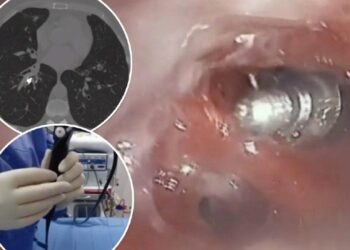 GAMBAR X-ray menunjukkan skru melekat pada paru-paru seorang wanita di Sepanyol.-AGENSI