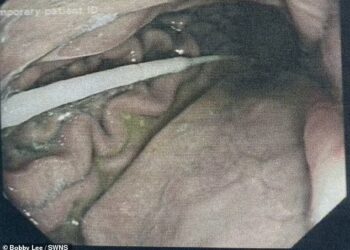 RAKAMAN menunjukkan pakar bedah mengeluarkan batang ujian calitan Covid-19 dari kerongkong wanita itu. - BOBBY LEE