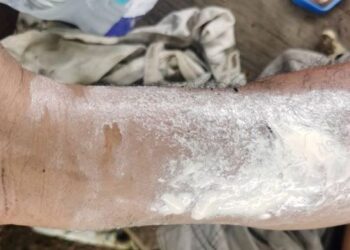 TANGAN Che Madiran yang melecur dalam kebakaran di Kampung Bunut Payong, Kota Bharu, Kelantan hari ini/
FOTO : ROSALWANI CHE SOH