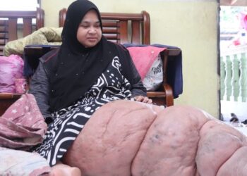KEADAAN kaki Sakila Ahmad Shamsuri yang membengkak akibat penyakit kaki gajah yang dihidapinya sejak empat tahun lalu ketika ditemui di Jelapang, Ipoh.