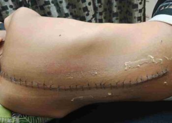 KEADAAN tulang belakang Muhammad Farez Murad yang dibedah akibat penyakit tulang bengkok. - UTUSAN/AIN SAFRE BIDIN