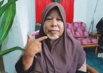 RAHMAH Mohd. Johan menunjukkan luka dialami selepas disamun di rumahnya di Felda Air Tawar 4, Kota Tinggi, Johor.