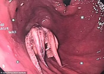 GAMBAR menunjukkan sotong kurita tersekat pada kerongkong pesakit itu. - AGENSI