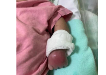 GAMBAR tular menunjukkan tangan bayi berusia dua bulan yang didakwa bengkak selepas mendapatkan rawatan demam campak di Hospital Melaka.