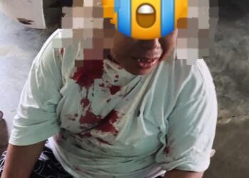 SEORANG wanita mengalami kecederaaan pada bahagian dagu selepas dilibas dengan parang dalam kejadian samun di Felda Air Tawar 4, Kota Tinggi.