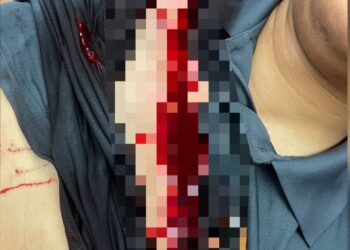 KEADAAN dada pegawai polis yang cedera selepas diserang seorang lelaki dalam kejadian di Taman Selasih, Kulim.