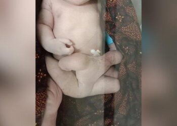 TANGKAP layar video yang menunjukkan seorang bayi lelaki kelihatan seperti mempunyai enam kaki di Lombok Timur. - AGENSI