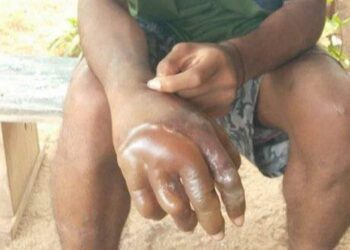 KEADAAN tangan seorang pelajar selepas gurunya mencelup tangannya ke dalam air panas dalam satu kejadian di Flores Timur, Nusa Tenggara Timur. - AGENSI