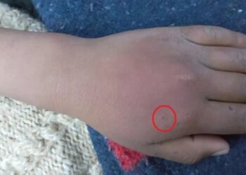 KESAN gigitan labah-labah di belakang tapak tangan kanak-kanak itu. - AGENSI    