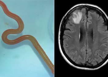 SPESIMEN larva ophidascaris robertsi yang dikeluarkan dari otak seorang pesakit wanita. - AGENSI 