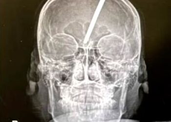 IMBASAN CT menunjukkan tempuling itu menembusi tengkorak jauh ke dalam otak mangsa. - AGENSI