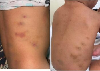 KESAN lebam pada badan seorang kanak-kanak berusia setahun yang didakwa telah didera oleh pengasuh dalam kejadian di Sikamat, Seremban.