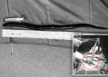 BELUT hidup sepanjang 30 sm dikeluarkan dari perut seorang lelaki di hospital Vietnam.-AGENSI