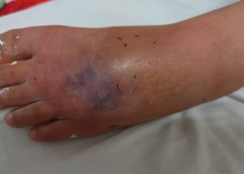 KECEDERAAN dialami kanak-kanak perempuan berusia lapan tahun akibat dibuli sekumpulan budak lain yang tular dalam kejadian di Kajang, Selangor.