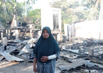 ROSNIZA Yusoff melecur di lengan kanan selepas disambar api dalam kejadian di Lorong Sate, Pengkalan Chepa, Kota Bharu, Kelantan hari ini.