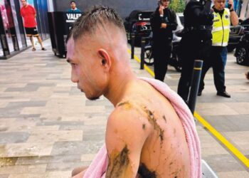Faisal Halim mengalami lecur tahap empat akibat disimbah asid. - Media Sosial