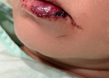 SEORANG wanita mengalami kecederaan pada bahagian bibir dalam cubaan culik di Taman Lagenda Putra, Kulai