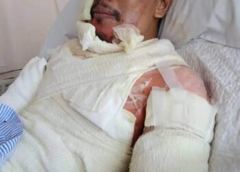 EDY Anuar melecur 30 peratus selepas terkena minyak panas akibat diserang sawan ketika berniaga di Taman Desa Cempaka, Nilai.