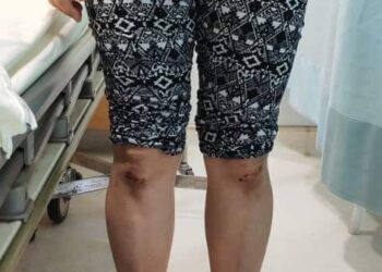 ANTARA kecederaan yang dialami seorang wanita berusia 47 tahun selepas empat lelaki bertindak cuba menculiknya ketika berada di depan rumah di Taman Lagenda Putra, Kulai.