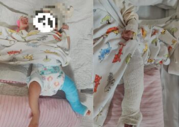 SEORANG bayi patah paha kiri disyaki semasa di bawah jagaan seorang pengasuh di Bandar Dato' Onn.