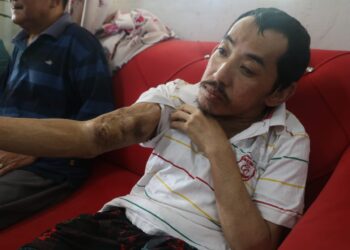 MOHD. Hafiz Suhaimi menunjukkan tapak saluran darah untuk rawatan hemodialisis yang sudah penuh di lengan kanannya. - UTUSAN/SALEHUDIN MAT RASAD