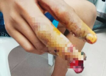 KEADAAN jari hantu pada tangan kanan mangsa yang putus selepas bermain mercun bola di Batu 23, Jalan Sawmill, Labok, Machang, Kelantan.