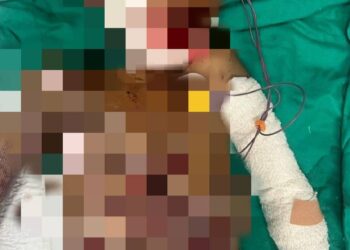 KEADAAN salah seorang mangsa yang parah akibat bermain mercun bola di Kampung Baru, Kuala Nerang dan kini dirawat di PICU HSB, Alor Setar, Kedah.