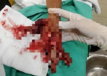 TANGAN seorang kanak-kanak yang cedera selepas terkena letupan mercun buatan sendiri di Tumpat, Kelantan.