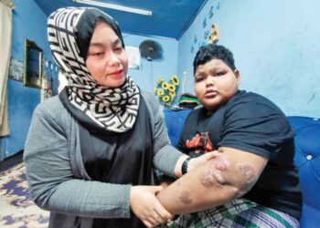 SITI Norhasibah Mohamed menunjukkan keadaan kulit yang luka akibat ekzema kronik dihidapi Irman Ezany Mohd. Izan di Kuala Terengganu. – UTUSAN/KAMALIZA KAMARUDDIN