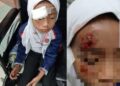 NUR QASYIFA HAZLINA Mohd. Hayider cedera parah di muka selepas terlibat dalam kemalangan langgar lari berhampiran SK Demang Hussin, Bukit Katil, Melaka.