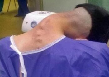 SINDROM kepala jatuh dikesan pada seorang pesakit di Iran.-AGENSI
