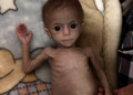 BAYI Palestin, Siwar Ashour mengalami malnutrisi akibat sekatan kemanusiaan di Semenanjung Gaza oleh Israel. - AGENSI