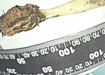 BERUS gigi sepanjang 17 sentimeter dikeluarkan daripada usus kecil seorang warga emas di China.-AGENSI