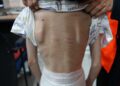 KESAN kecederaan pada tubuh mangsa kanak-kanak berusia 11 tahun yang dipercayai didera secara fizikal oleh ibu dan bapa kandungnya dalam kejadian di Taman Desa Saujana, Arau, Perlis semalam.