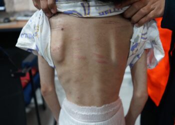 KESAN kecederaan pada tubuh mangsa kanak-kanak berusia 11 tahun yang dipercayai didera secara fizikal oleh ibu dan bapa kandungnya dalam kejadian di Taman Desa Saujana, Arau, Perlis semalam.