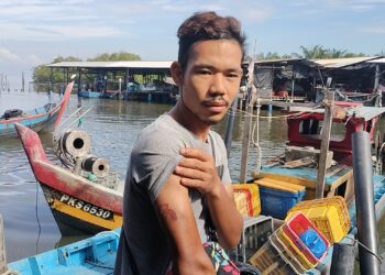 MOHD. Hariz Ahmad Radzi menunjukkan lengan kanannya yang melecur dalam kejadian bot terbakar di perairan Kerian semalam. - UTUSAN/WAT KAMAL