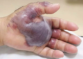 BAKTERIA Vibrio vulnificus dilapor memusnahkan tisu kulit sehingga menjadi hitam dan mati. – AGENSI
