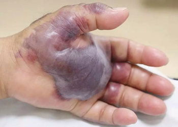 BAKTERIA Vibrio vulnificus dilapor memusnahkan tisu kulit sehingga menjadi hitam dan mati. – AGENSI